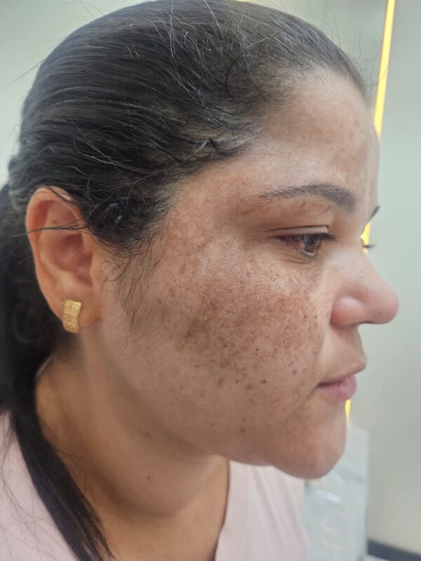 Antes do tratamento para melasma