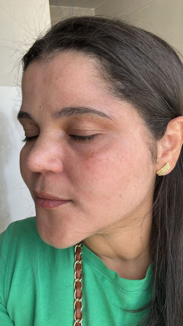Depois do tratamento para melasma
