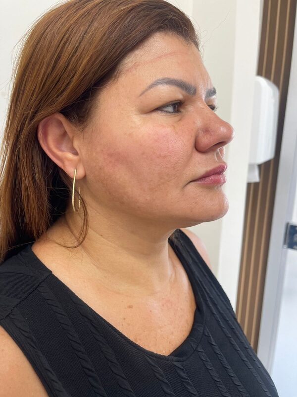 Depois do tratamento com Hi-Pro e Bioestimulador de Colágeno