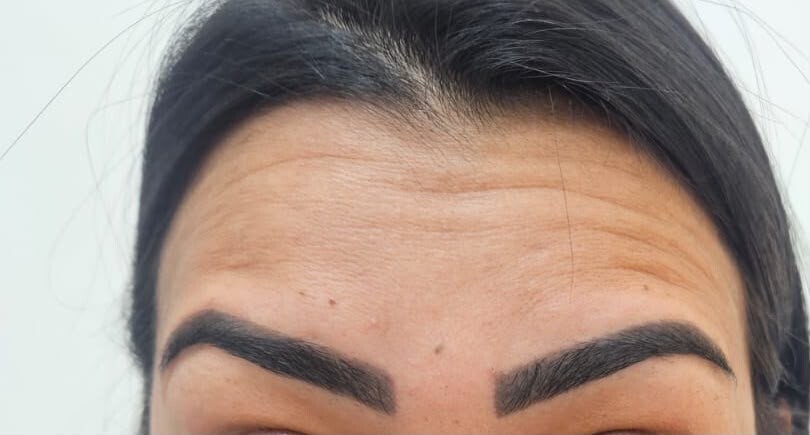 Antes do tratamento com botox