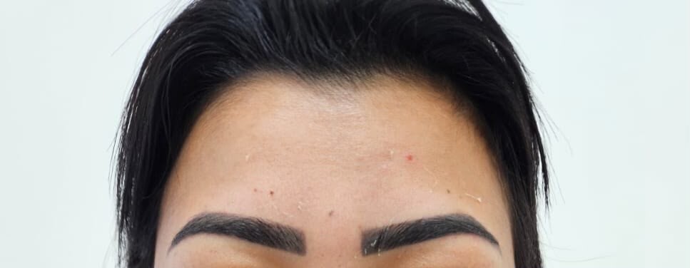 Depois do tratamento com botox